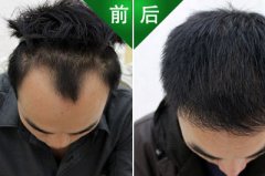 治好脱发，终于可以拍婚纱照了