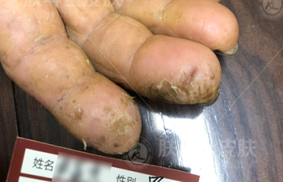 湿疹2