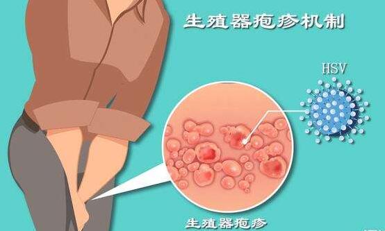 生殖器疱疹的复发原因【厦门广肤皮肤病医院】